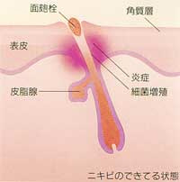 ニキビのできてる状態